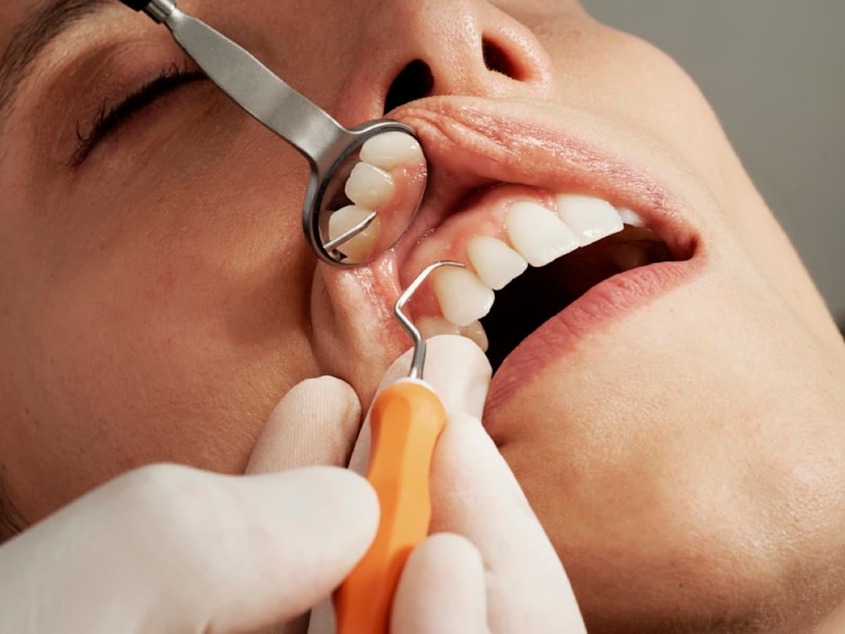 Dentista trabajando en los dientes frontales de un paciente